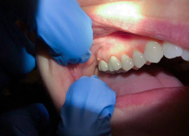 Best Emergency Dentist for Knocked-Out Tooth in Llano, TX